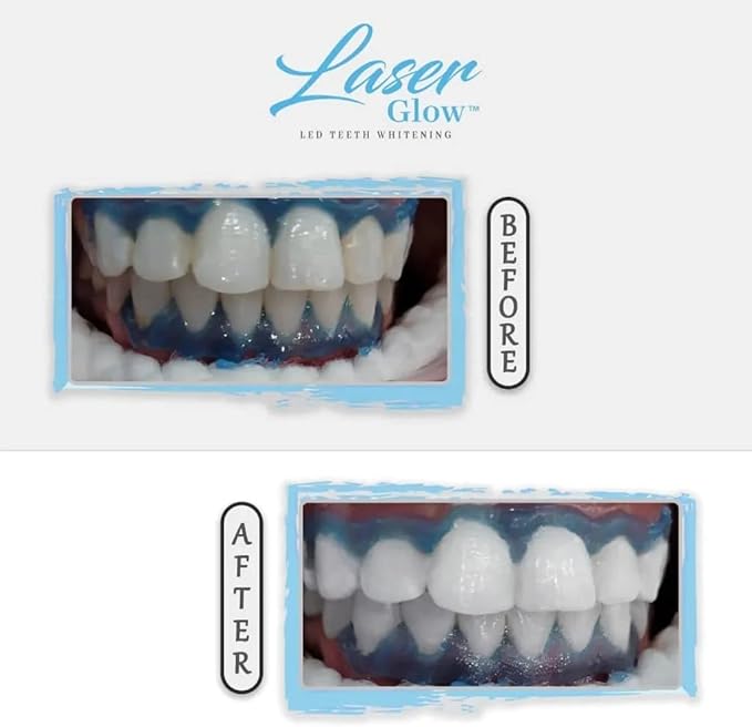 LaserGlow Professional Teeth Whitening Gel 44% Hydrogen Peroxide – Dual Barrel Syringe for Fast, Effective, and Whitening Results | Hydrogen Peroxide Gel, Teeth Whitener, Tooth Whitening Gel