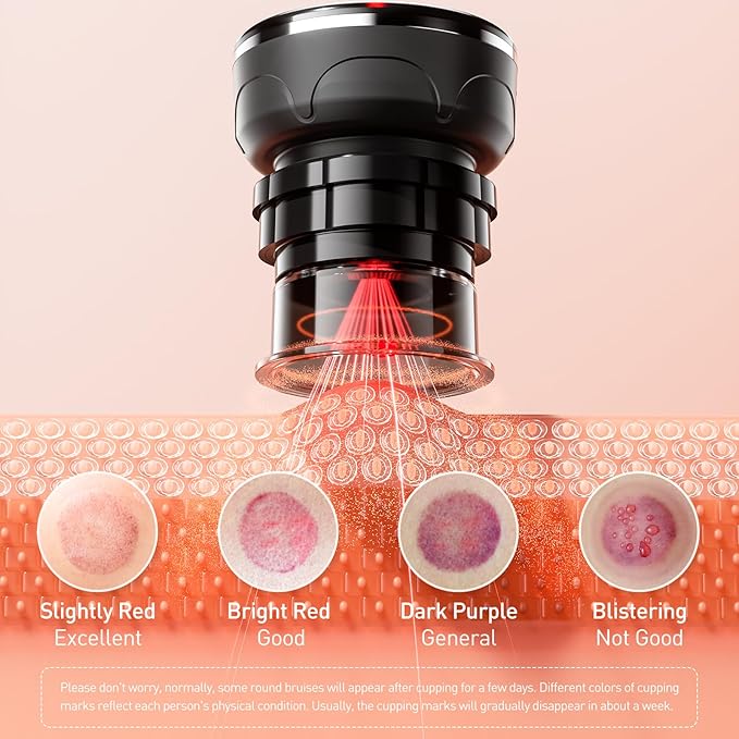 UBALANCE Smart Cupping Therapy Set - Cellulite Massager with 6 Massage Cups, Portable Electric Device for Enhanced Blood Circulation, Reduced Cellulite, and Muscle Soreness Relief(Black)